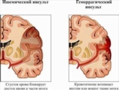 Сроки и правила оплаты нахождения на больничном после инсульта в 2024 году для работающих